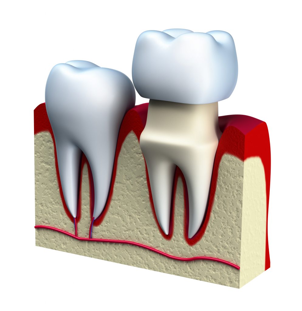 Dental crown installation process in Tigris Dental Care Liverpool