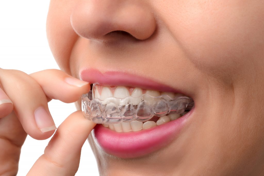 Invisalign adn Orthodontic